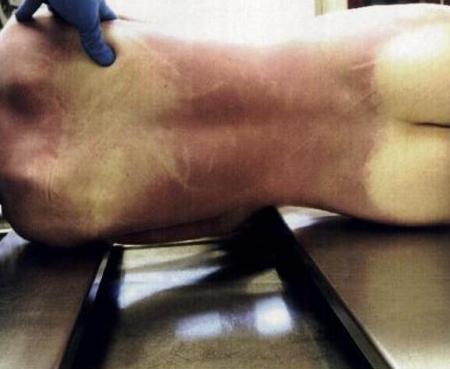 Morgue photo with pinkish discoloration