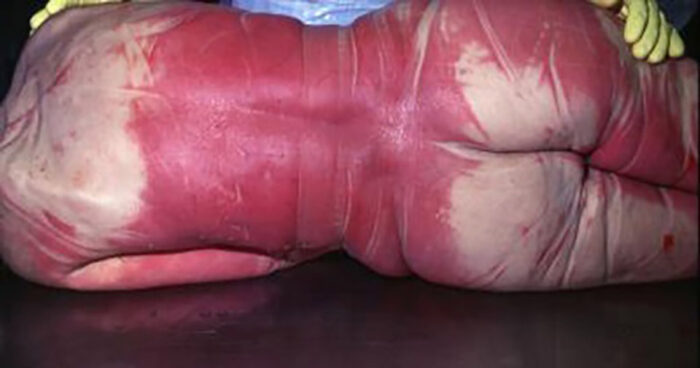 Pink skin-discoloration of victim of carbon-monoxide poisoning
